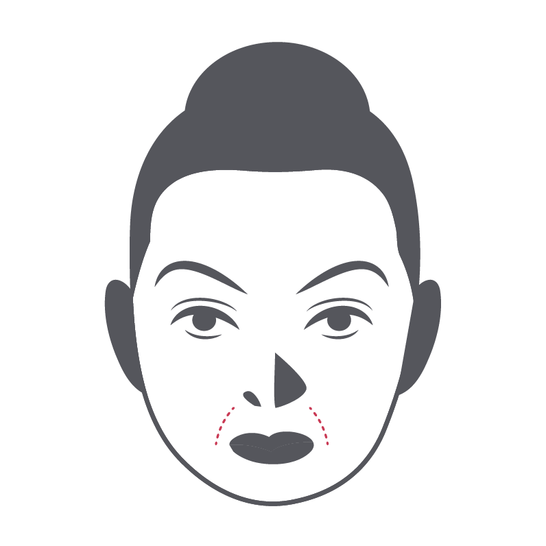 Nasolabial Folds