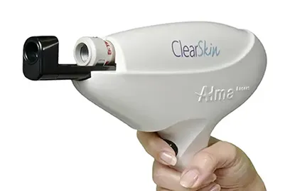 Long Pulsed Yag Laser